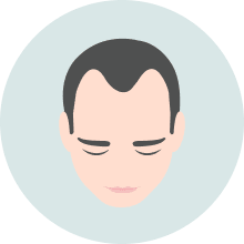 Hair Loss Landing Image