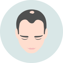 Hair Loss Landing Image